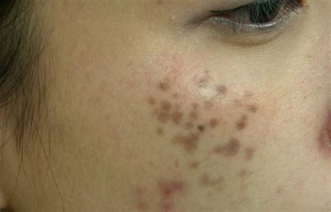 顴骨斑|顴骨母斑（NEVUS ZYGOMATICUS）